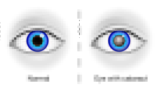 Cataract Illustration