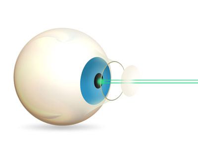 LASIK eye surgery