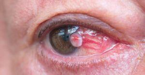 Eye with Pterygium
