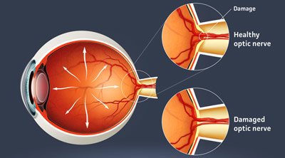 Glaucoma treatment