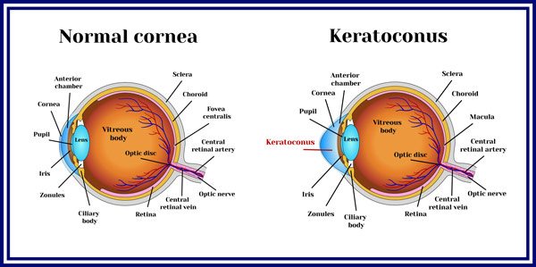 Keratoconus illustration