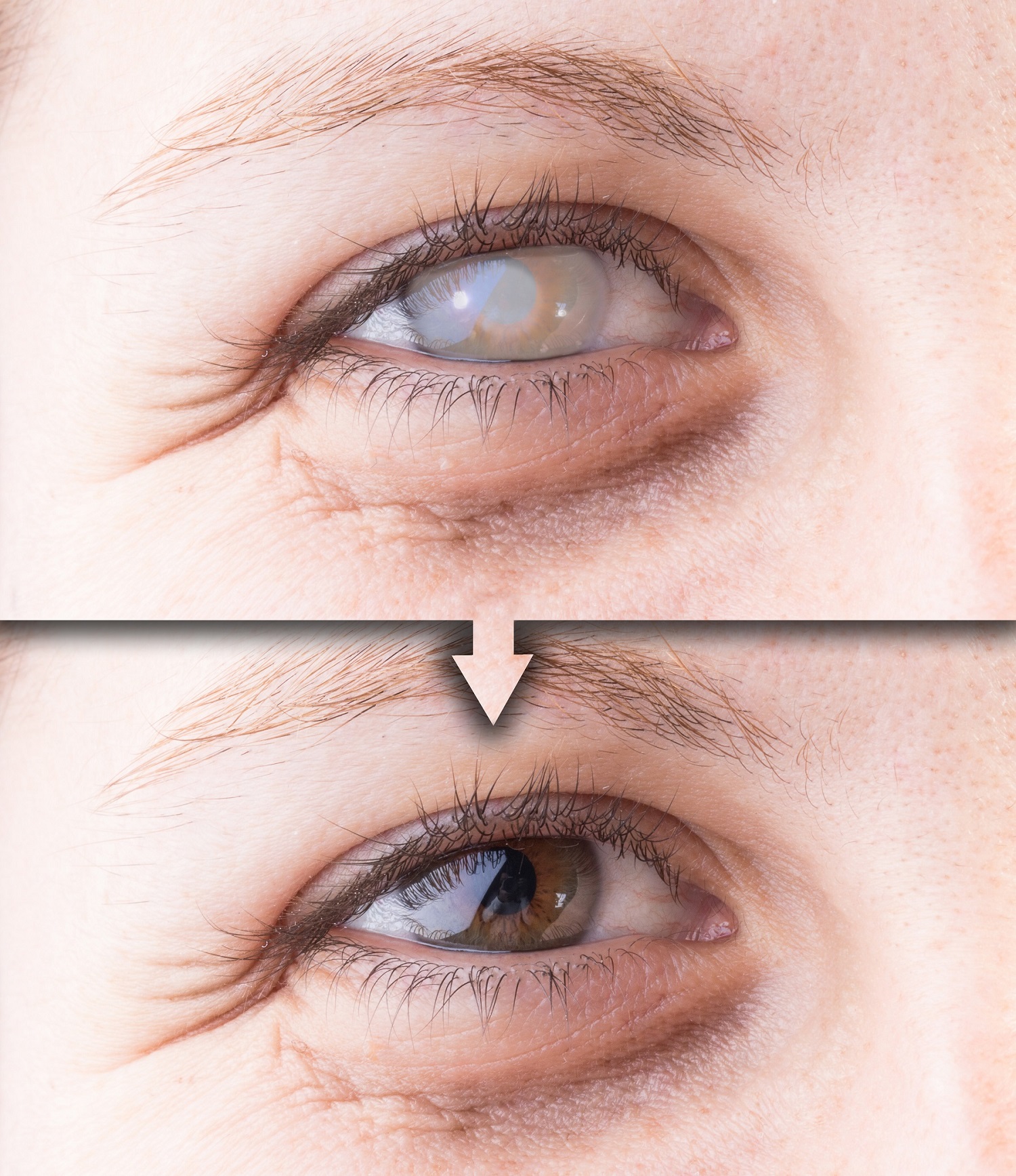 Eyes with and without cataract and corneal opacity
