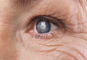 Cataract concept. Senior woman's eye