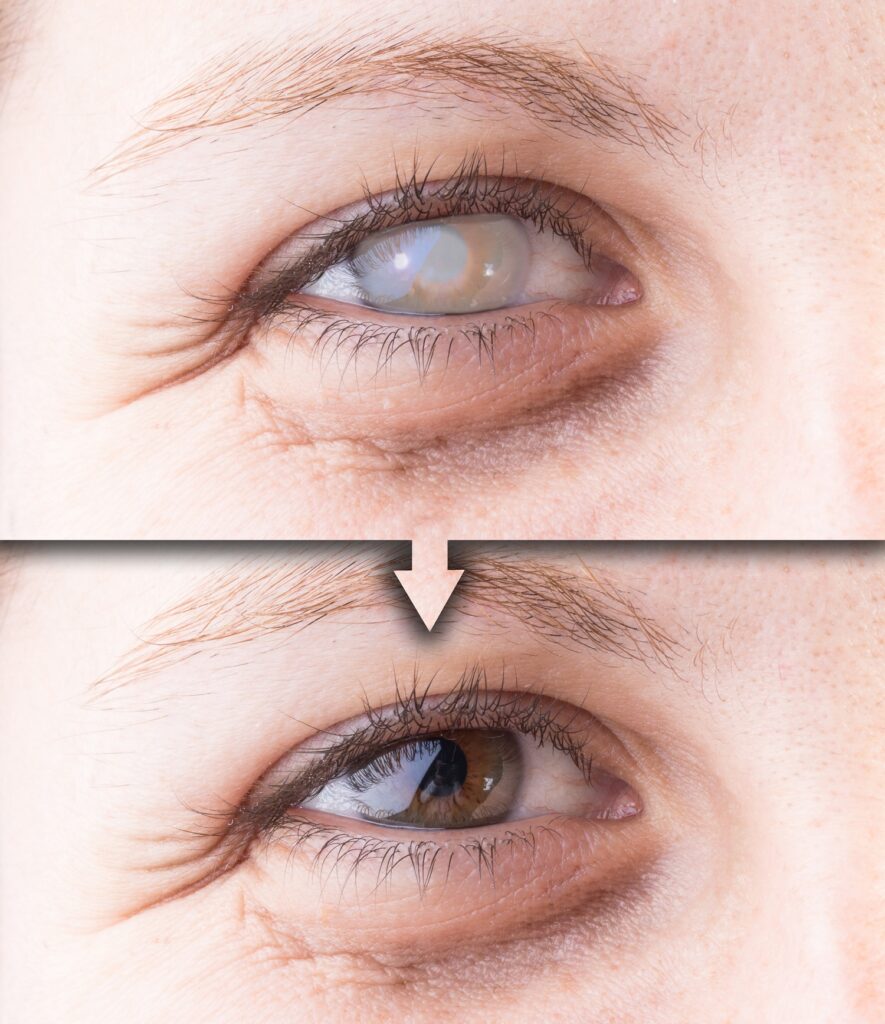 Eye with cataract and corneal opacity before and after surgery