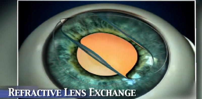 Refractive Lens Exchange